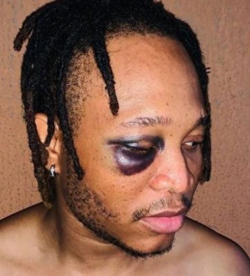 Picture Of Viktoh With 'Swollen Eye' After Police Assault Surfaces Online  