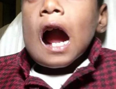 Doctor Removes 526 Abnormal Teeth From 7-year-old Boy  