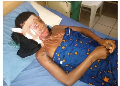 "Don't Allow My Dream To Die", 18-yr-old Acid Bath Victim Cries For Help  