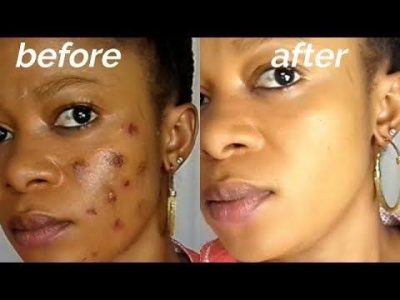 How To Use Bitter Leaf To Clear Pimples, Acne And Blackheads In Five Days  