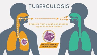 NTBLCP Warns Nigerians: Tuberculosis is not caused by witchcraft  