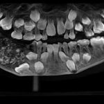 Doctor Removes 526 Abnormal Teeth From 7-year-old Boy  