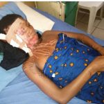 "Don't Allow My Dream To Die", 18-yr-old Acid Bath Victim Cries For Help  