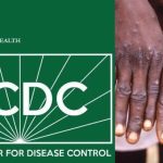 Monkeypox: Nigeria Records 21 Cases, 1 Death  