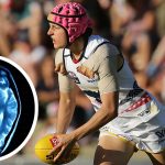 First Known Case of Chronic Traumatic Encephalopathy (CTE) Found in Female Athlete  